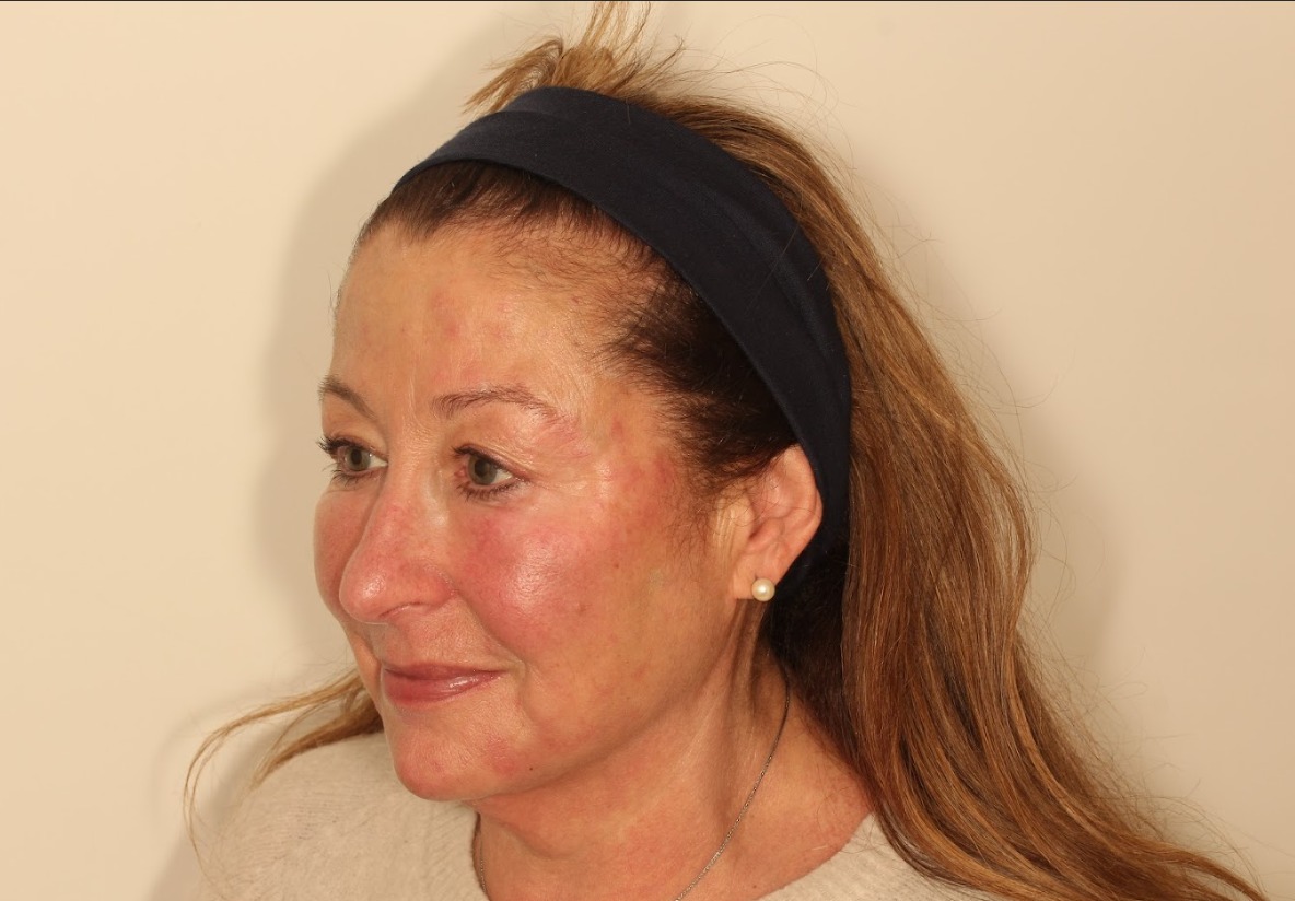 After mid-cheek and chin revolumisation - restored volume and rejuvenated appearance
