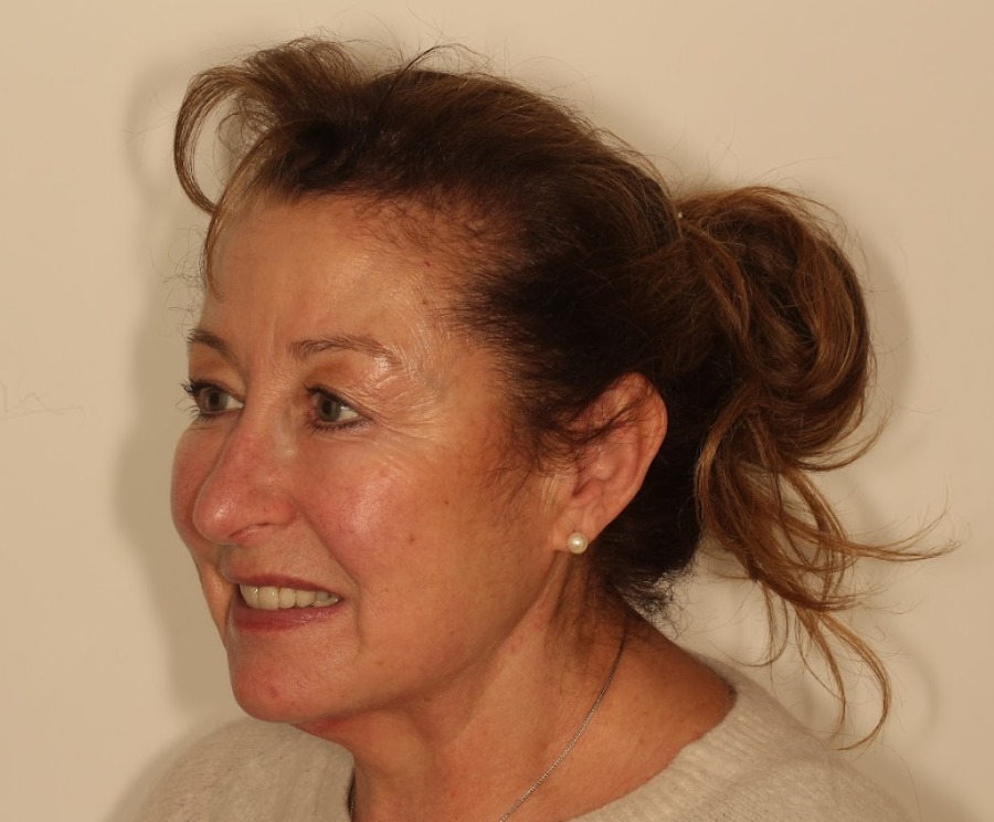 Before mid-cheek and chin dermal filler - loss of facial volume and definition