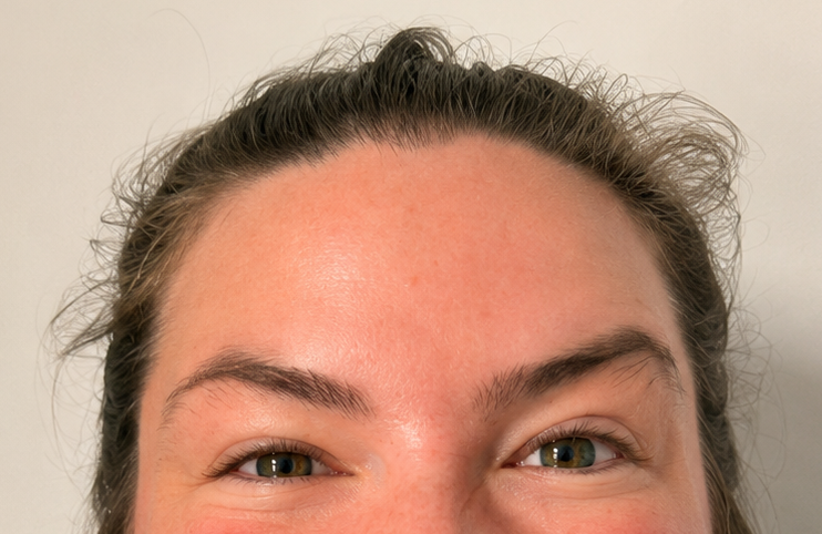 After anti-wrinkle injections - relaxed expression lines and refreshed appearance