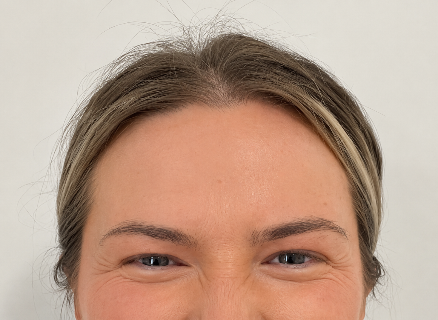 Before anti-wrinkle injections - visible expression lines at rest