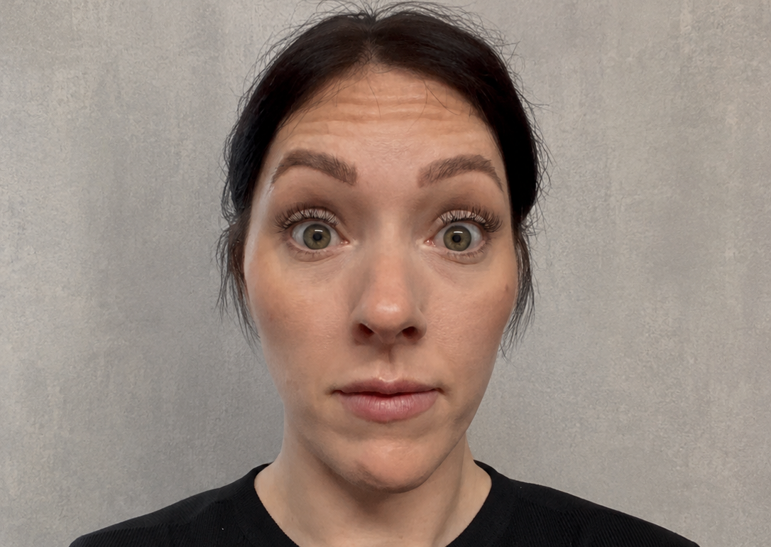 Before anti-wrinkle treatment - forehead lines visible during movement