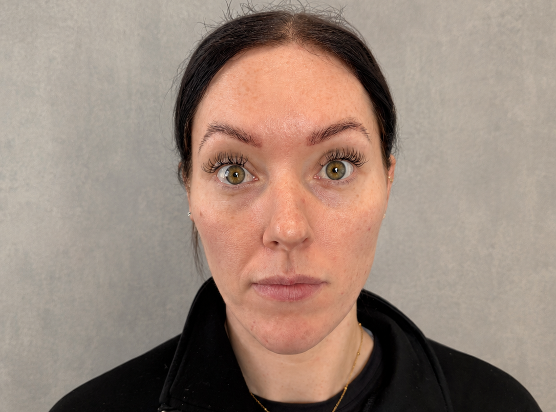 After anti-wrinkle treatment - forehead lines smoothed for a refreshed appearance