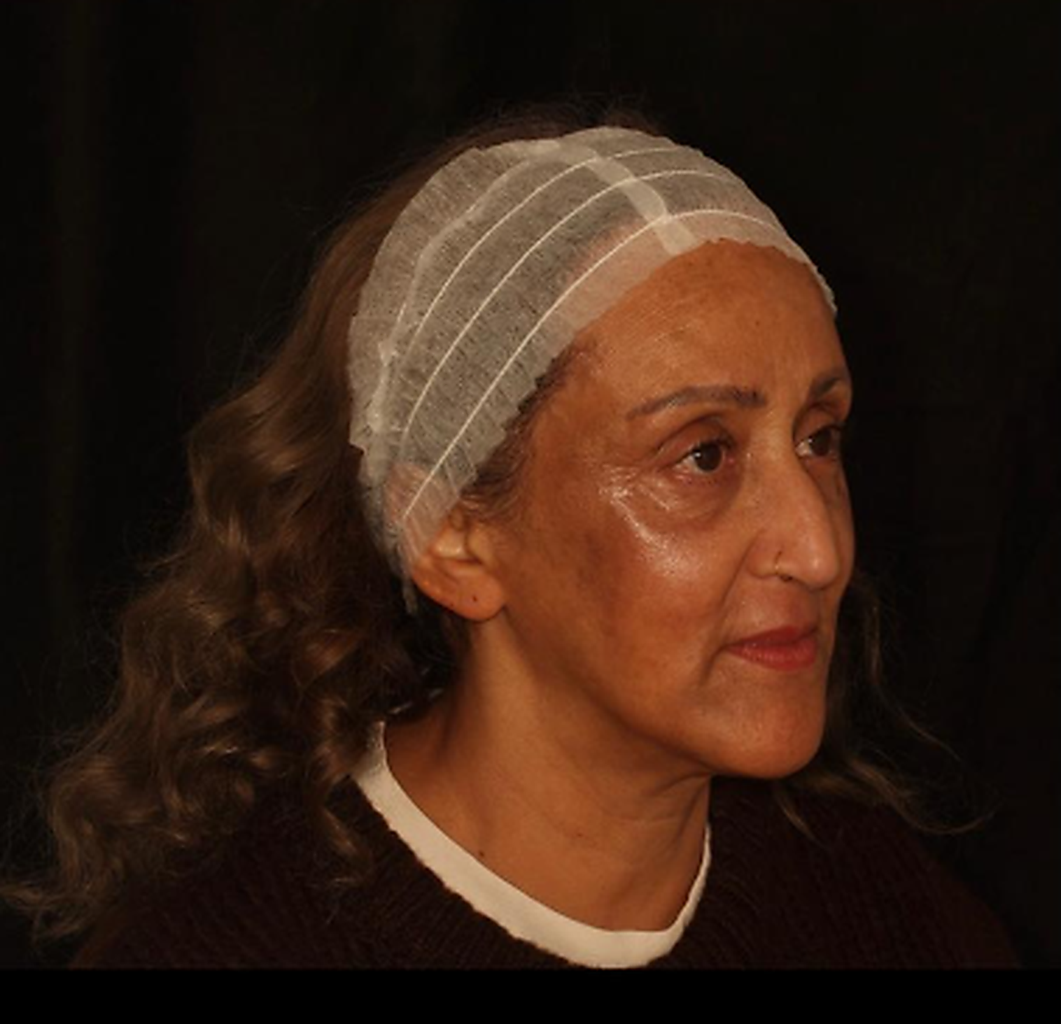 After skin treatment - improved skin tone, texture, and overall complexion