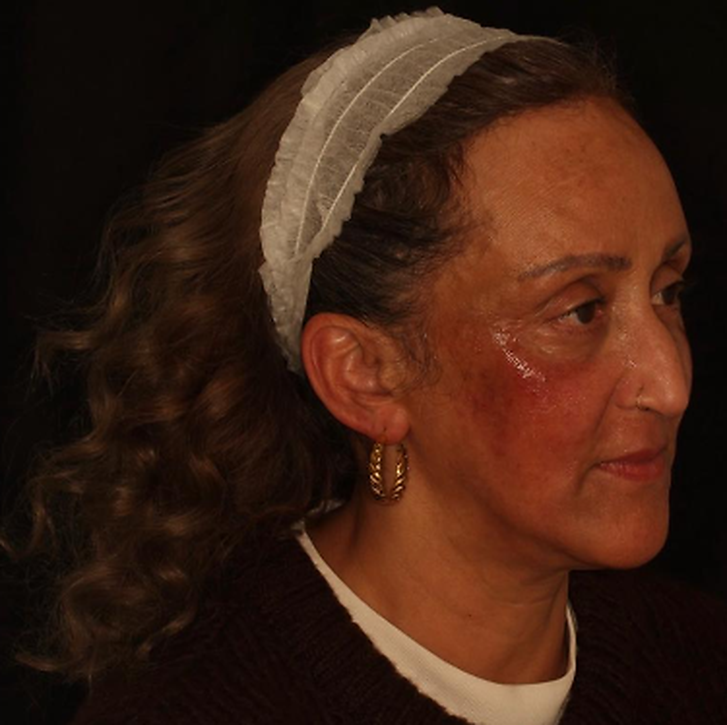Before skin treatment - uneven skin tone and visible texture concerns