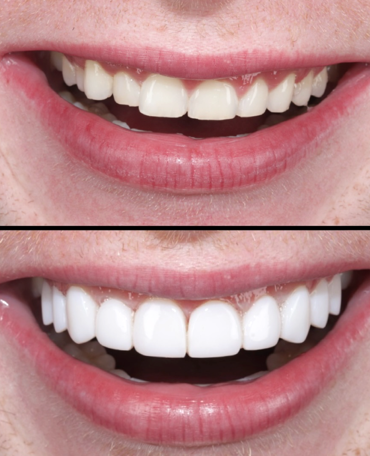 Before and after smile makeover - The Smile Boutique