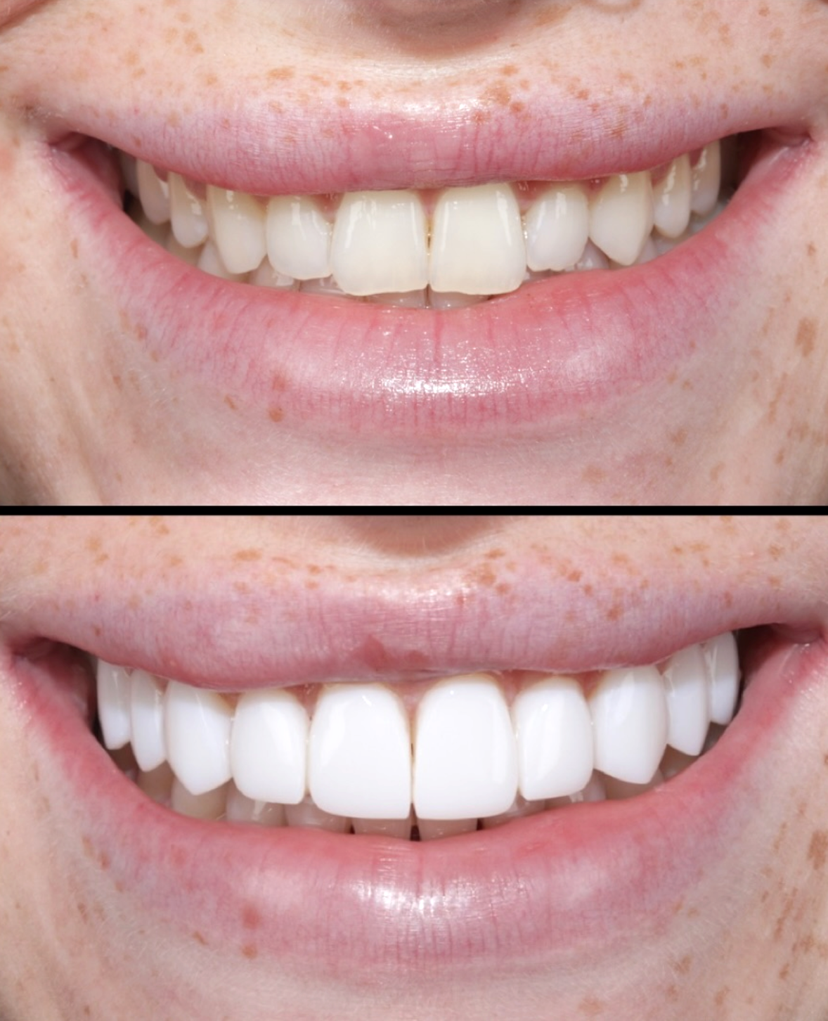 Before and after composite bonding result - The Smile Boutique