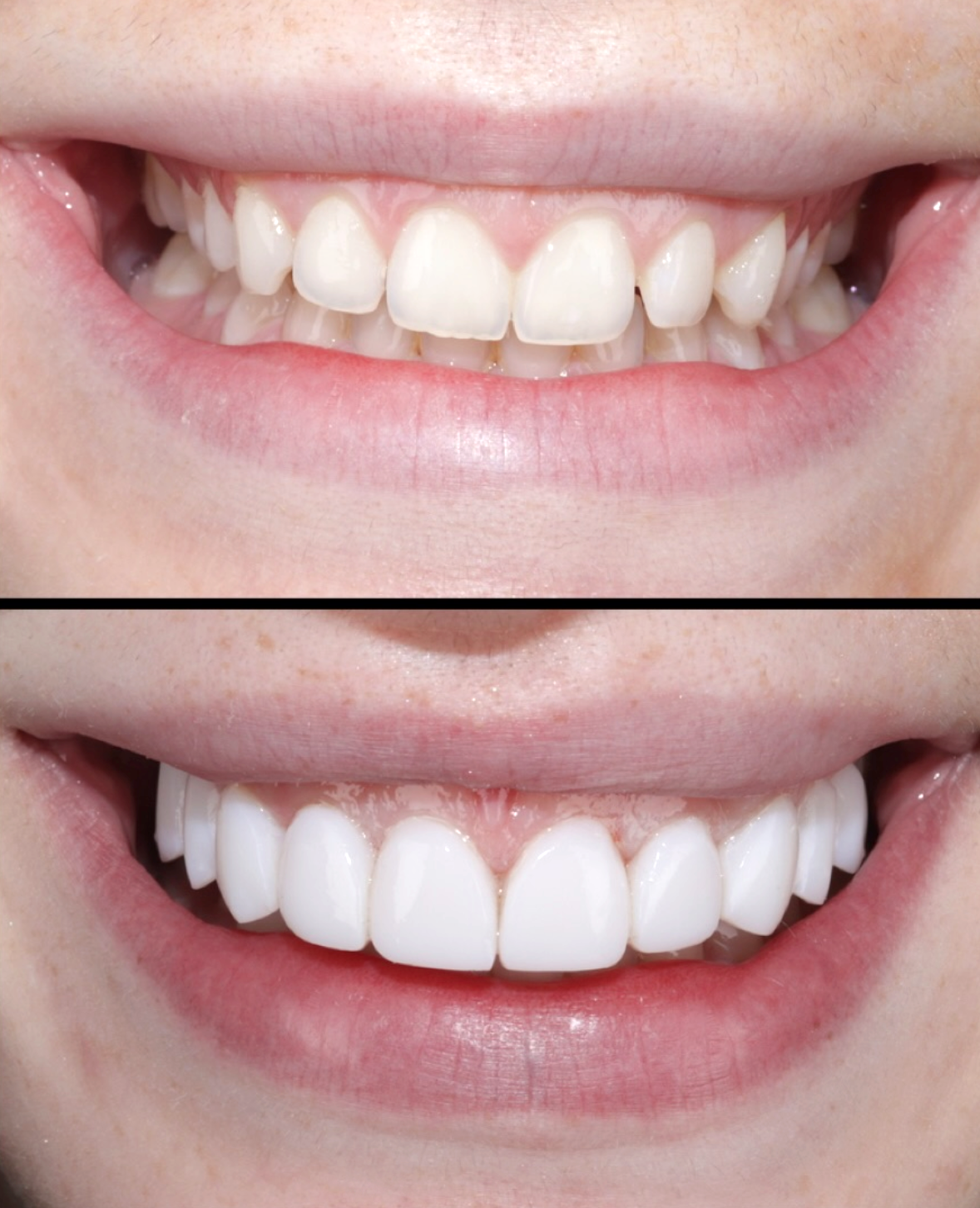 Before and after smile transformation - The Smile Boutique