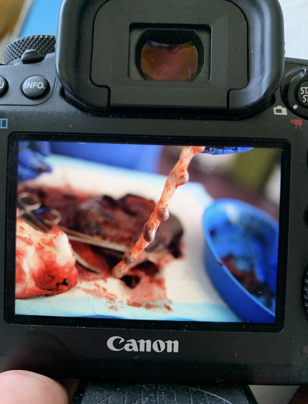 A photo of the back of a digital camera showing a photo of a placenta with the umbilical cord in focus A photo of the back of a digital camera showing a photo of a placenta with the umbilical cord in focus