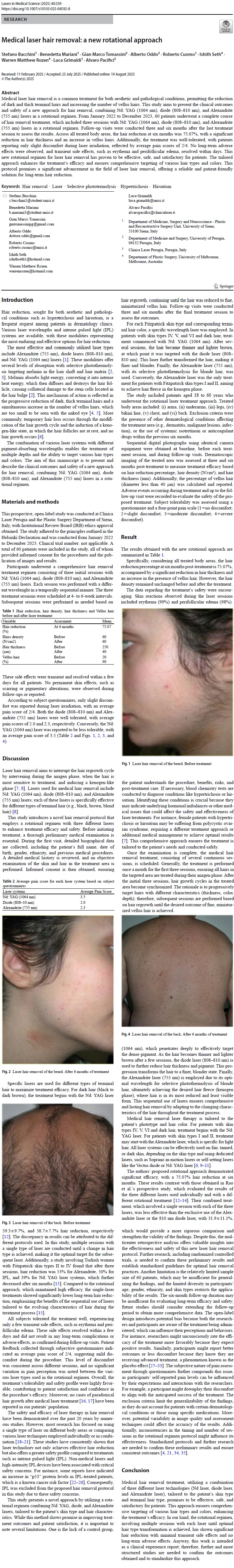 Before and after clinical results of a rotational medical laser hair removal treatment using a sequence of Nd:YAG, Diode, and Alexandrite lasers. The image displays treatment progress on a patient's beard area and back, showcasing a significant 75% reduction in thick terminal hair alongside a data table tracking the conversion of dense hair into fine vellus hair over 6 months.