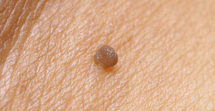 The Key Benefits of Skin Tag Removal