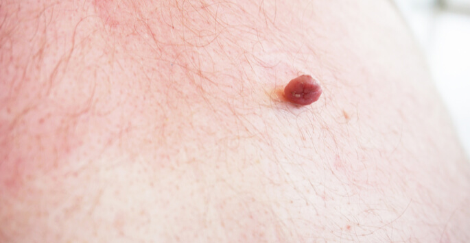 how-to-remove-skin-tags how-to-remove-skin-tags