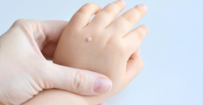 what-causes-warts