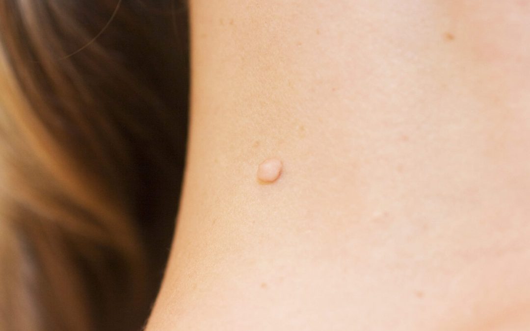 skin-tag-removal-how-does-it-work skin-tag-removal-how-does-it-work
