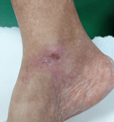 Venous stasis wounds after treatment