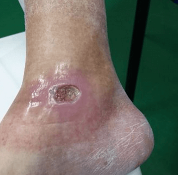 Venous stasis wounds before treatment
