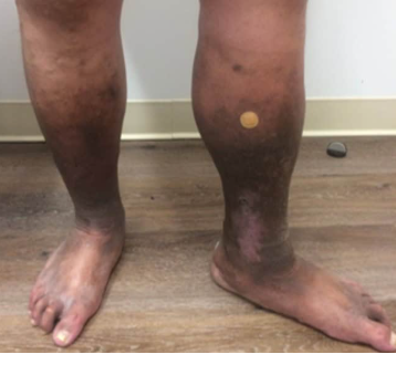 Ankle ulcer after treatment