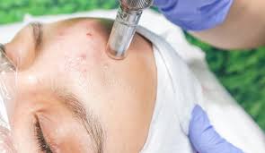 Microneedling treatment