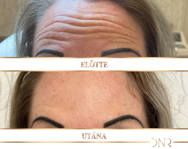 Botox kezelés