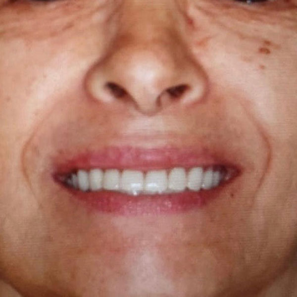 Dopo: sorriso fisso su impianti