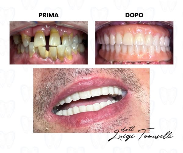 Prima e dopo: riabilitazione completa del sorriso