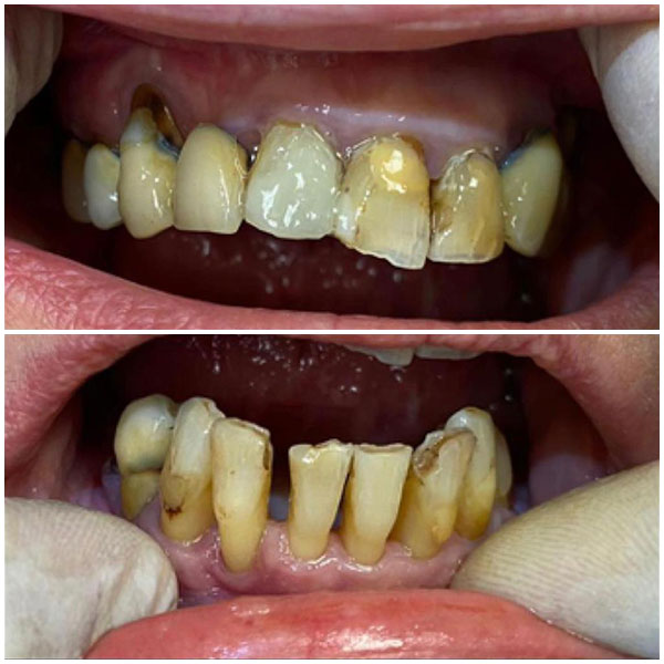 Prima: denti gravemente compromessi
