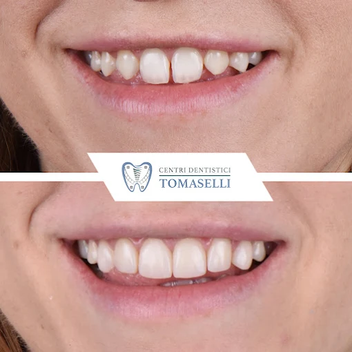 Prima e dopo: rifacimento estetico del sorriso