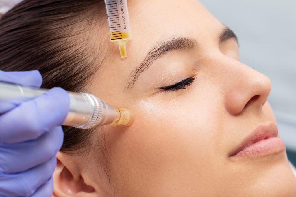 Vampire Facial PRP micro-needling treatment at AlphaBoost Medical Clinic in Sterling, Virginia