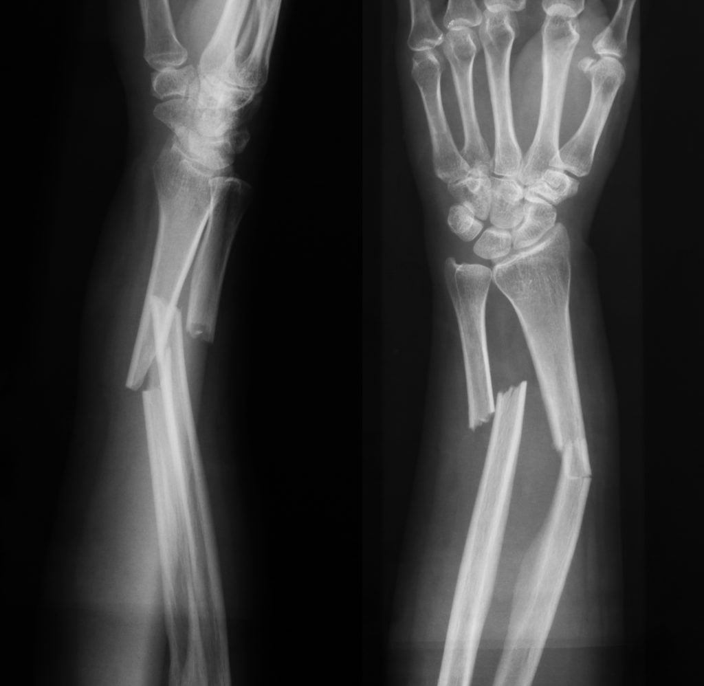 BROKEN WRIST WITHOUT SURGERY $43,000 vs. BROKEN WRIST WITH SURGERY $100,000