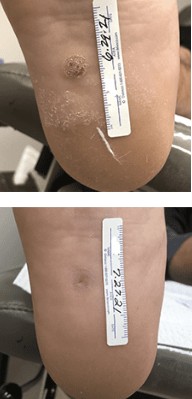swift treatment pictures patient 4