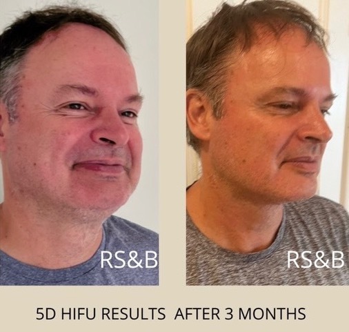 Before and after HIFU result 2