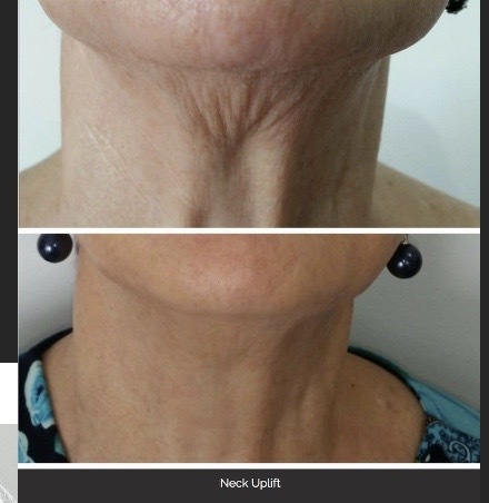 Before and after HIFU result 1