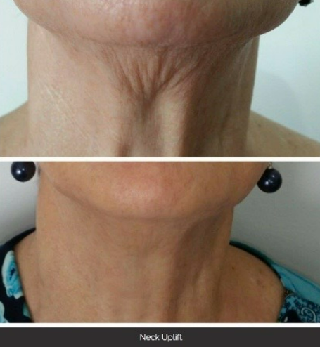 Before and after HIFU result 1