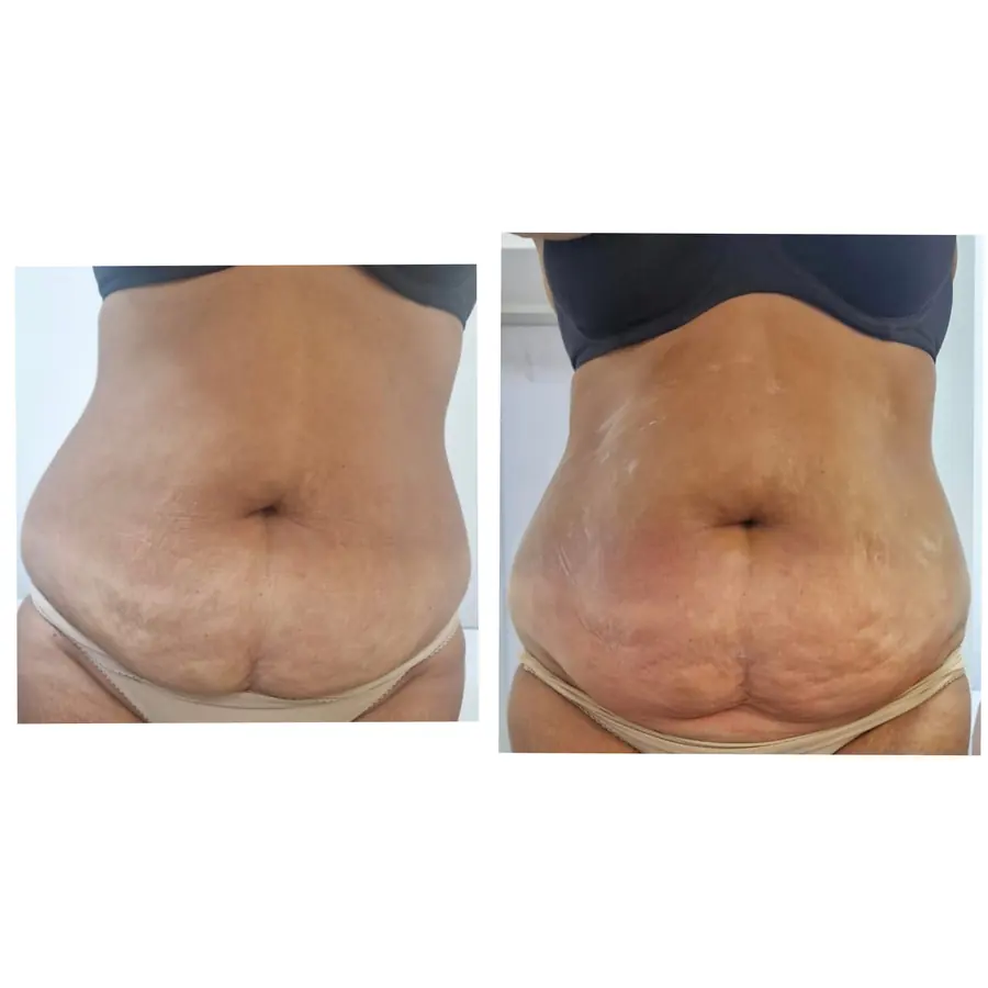 Abdomen înainte și după o serie de ședințe de remodelare corporală, poză trimisă de Ramona Vermeșan