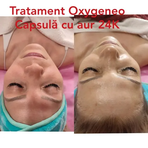 Ten înainte și după tratament Oxygeneo cu capsulă cu aur 24K