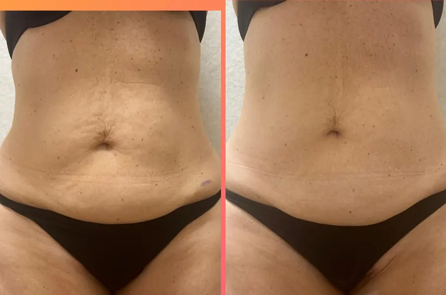 Abdomen &icirc;nainte și după o serie de ședințe de remodelare corporală la Ramo Cosmetic House, Timișoara