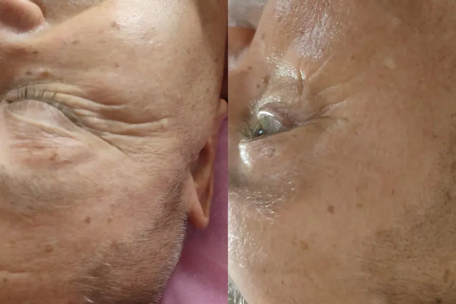 Zona ochiului înainte și după un tratament facial cu produse Sothys, în salonul Ramonei Vermeșan