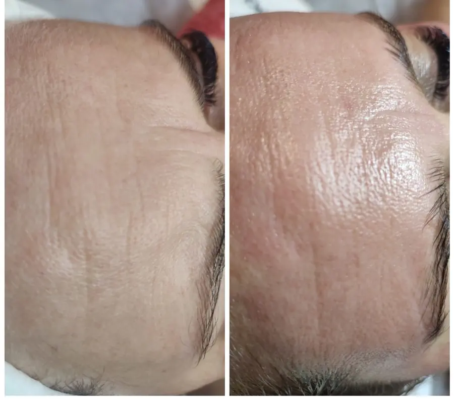 Fruntea unei cliente &icirc;nainte și după microneedling, poză din salonul Ramonei Vermeșan din Timișoara