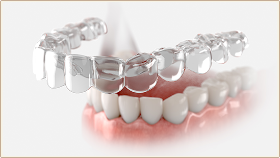 Clear Aligners