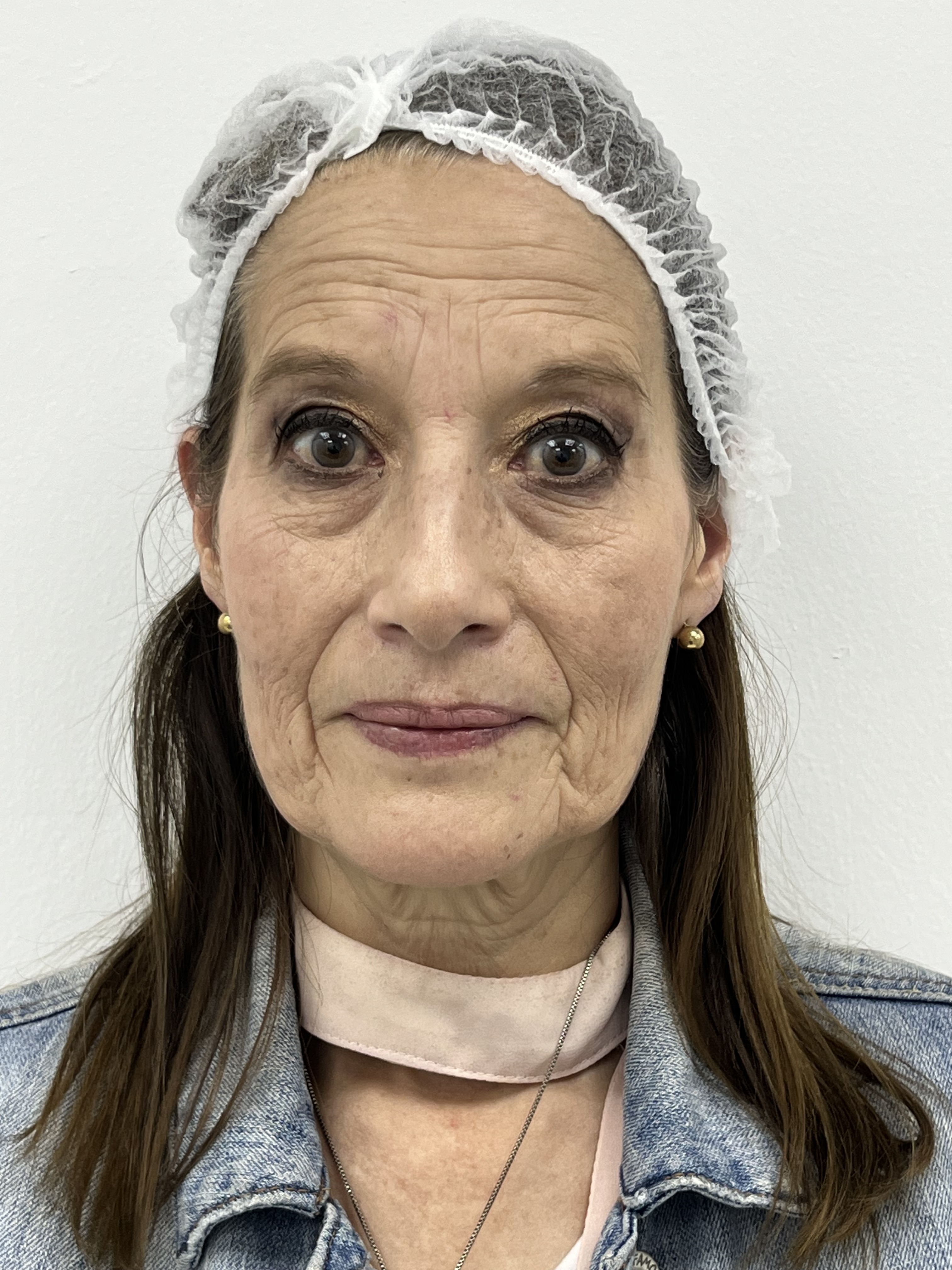 Líneas del entrecejo — antes