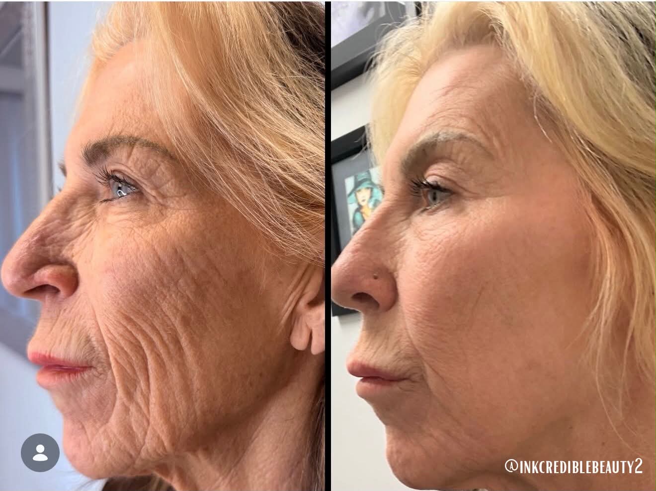 Before and after Ultra Cold T33 Jet Plasma treatments