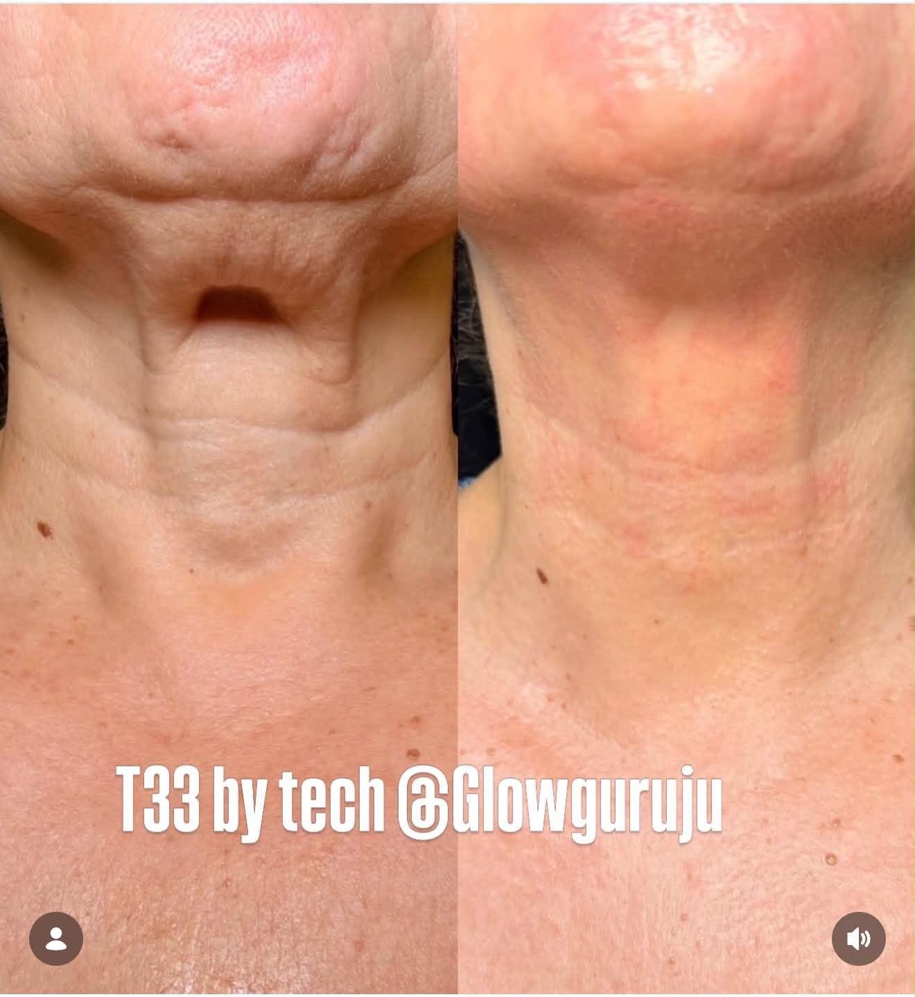 Neck before and after Ultra Cold T33 Jet Plasma treatments
