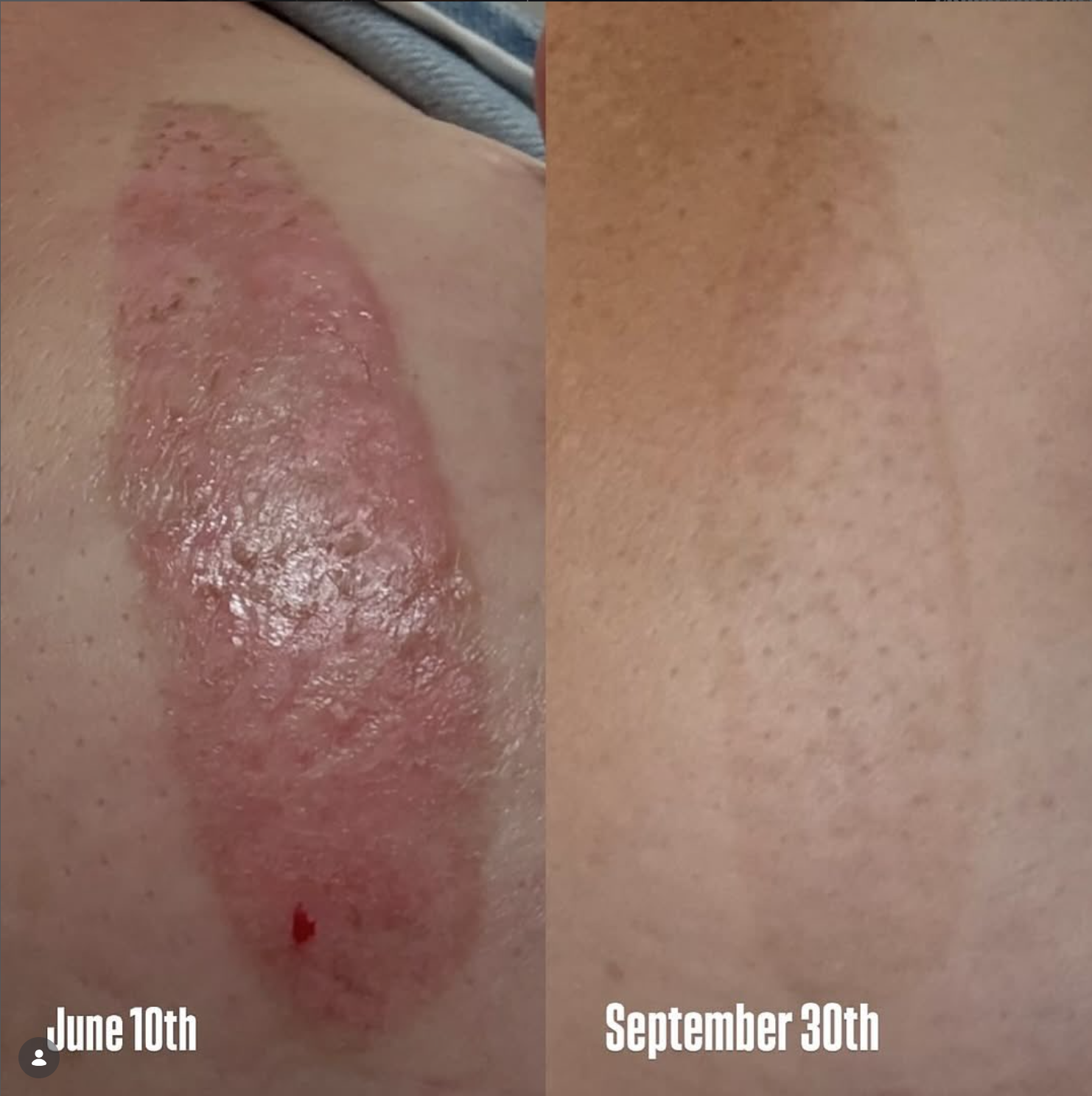 Scar before and after Ultra Cold T33 Jet Plasma treatments