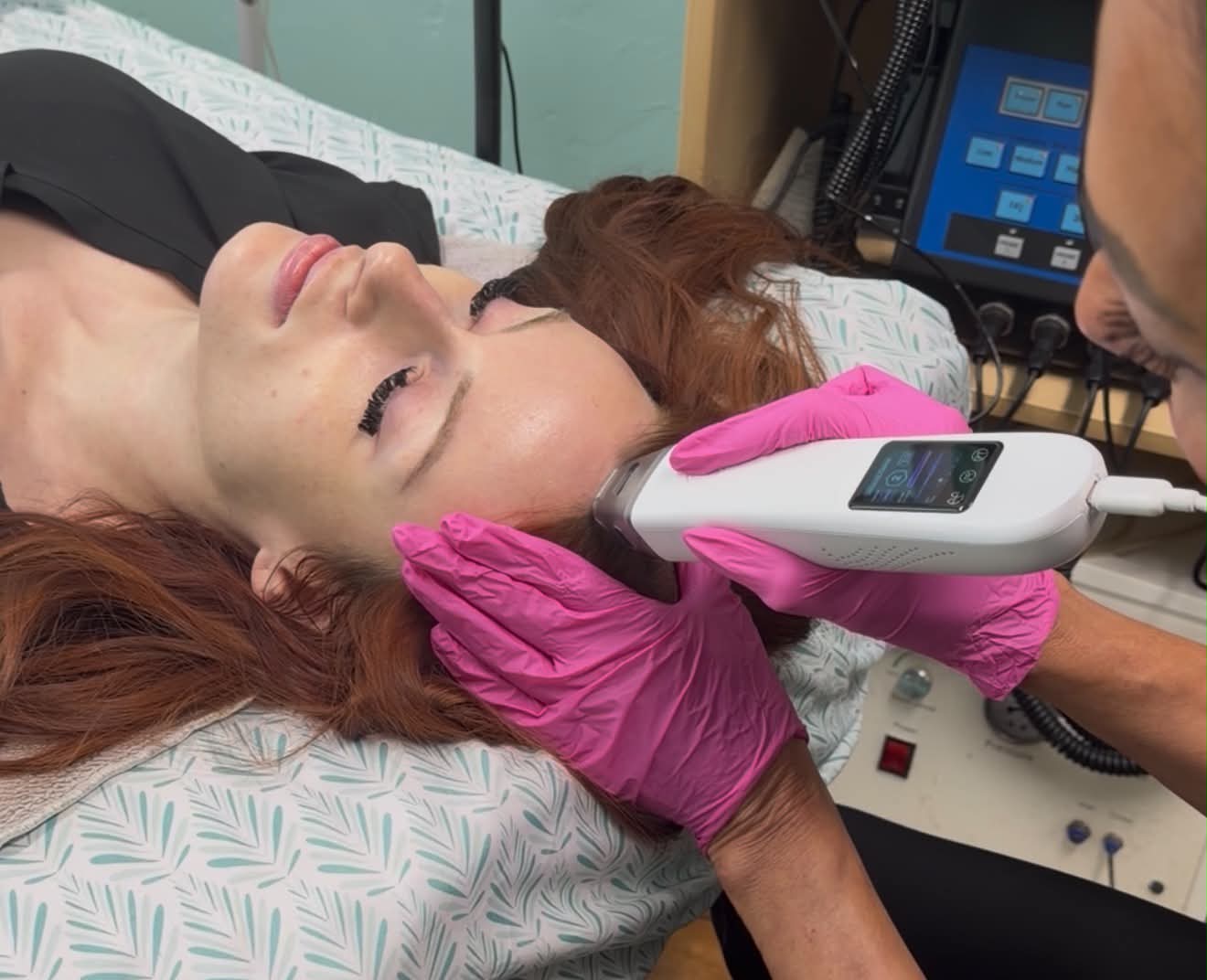Scalp before and after a series of Ultra Cold T33 Jet Plasma treatments