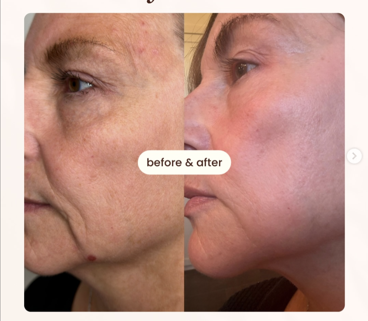 Face before and after Ultra Cold T33 Jet Plasma treatments