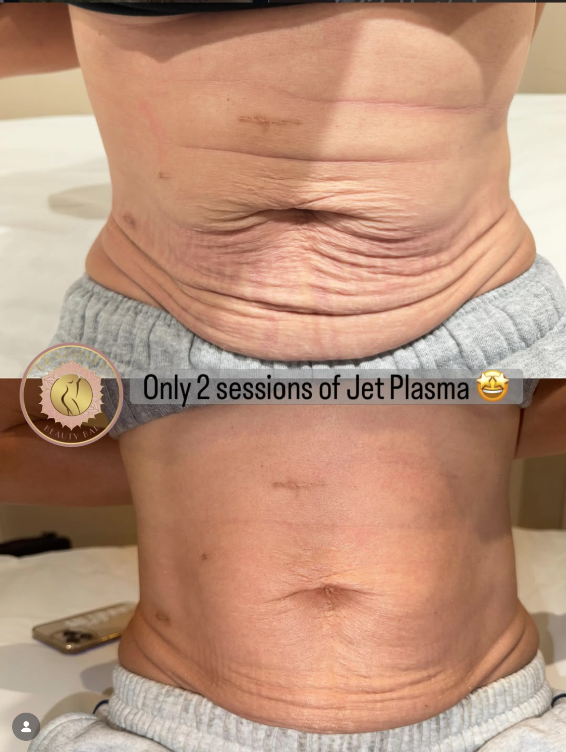 Stomach before and after Ultra Cold T33 Jet Plasma treatments