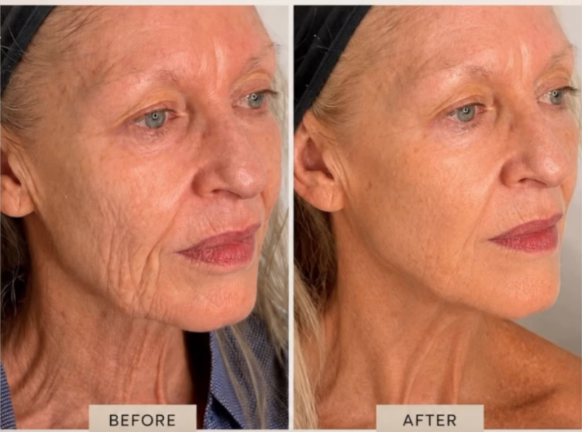 Face before and after one Ultra Cold T33 skin tightening session