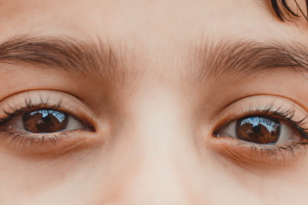 kid with dark circles under eyes kid with dark circles under eyes