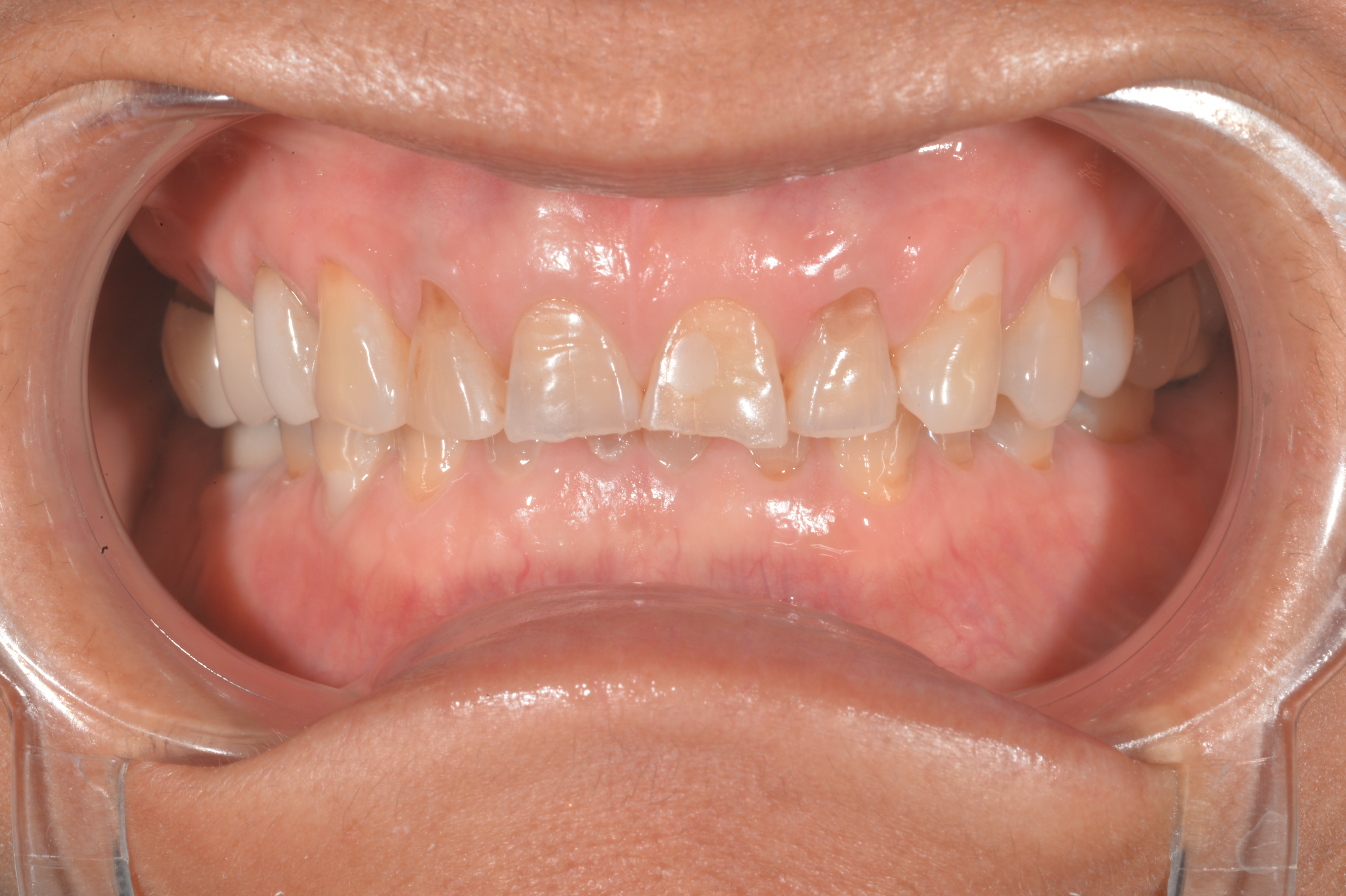 Teeth before bruxism treatment