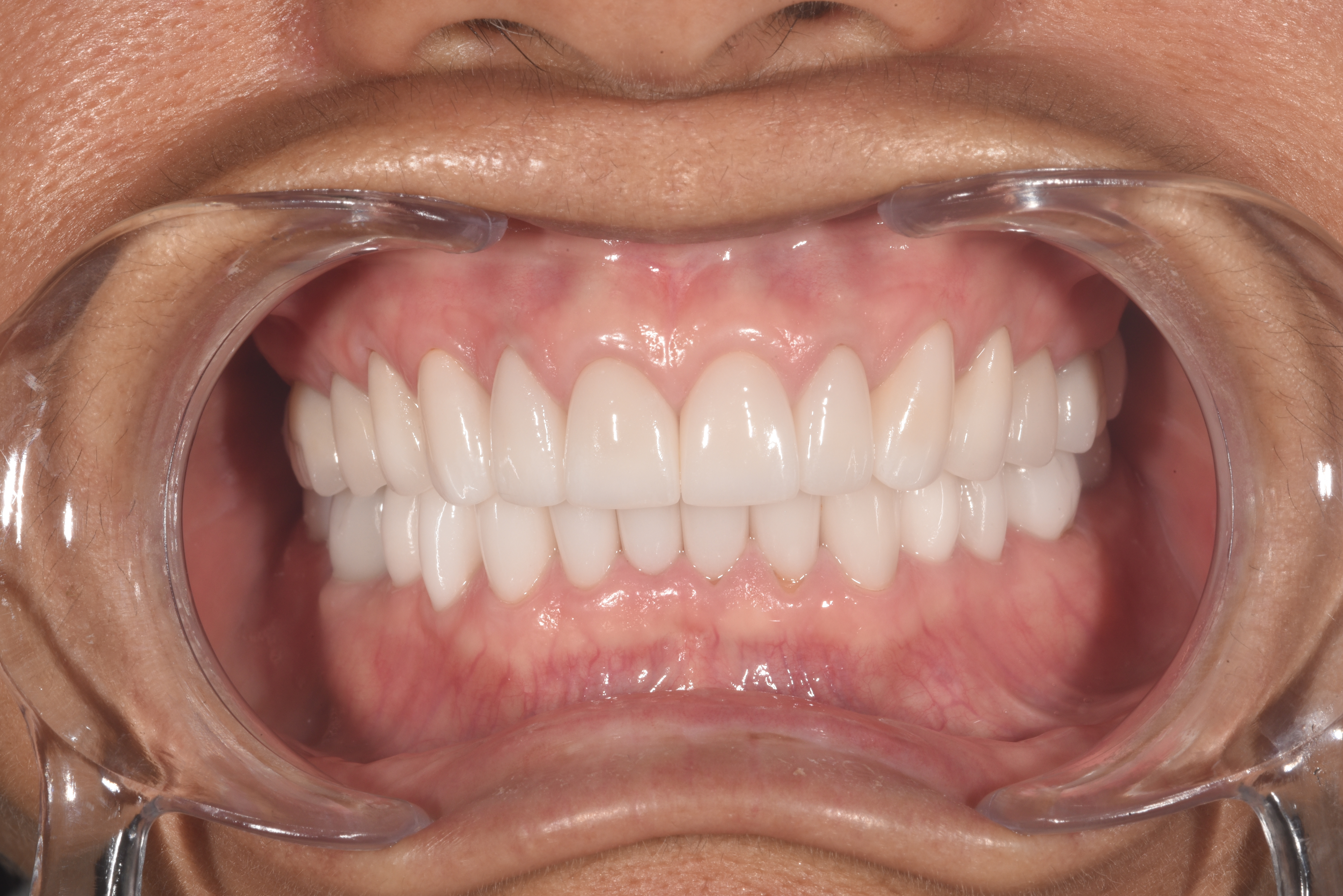 Teeth after bruxism treatment