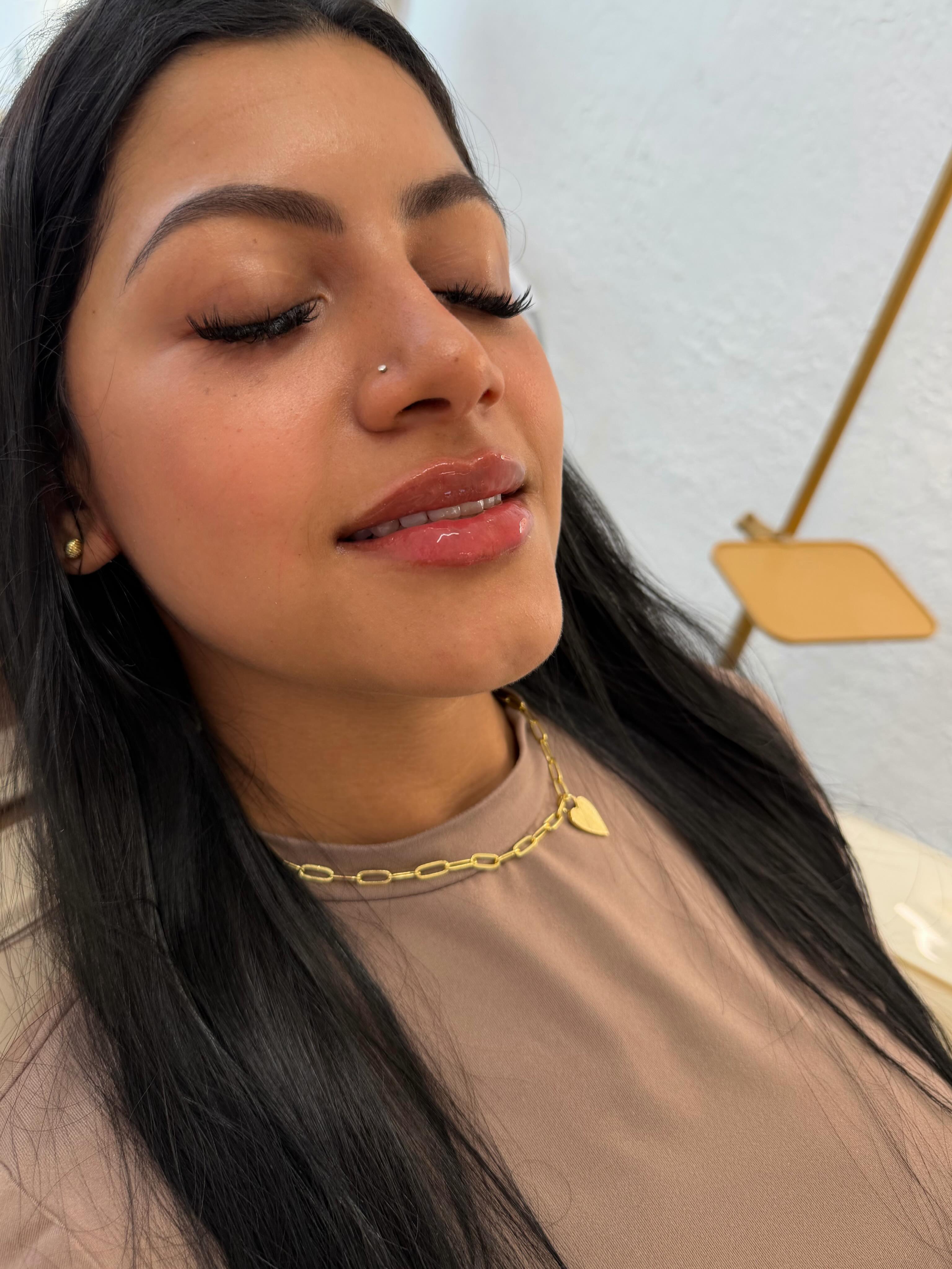 Fillers — lábios